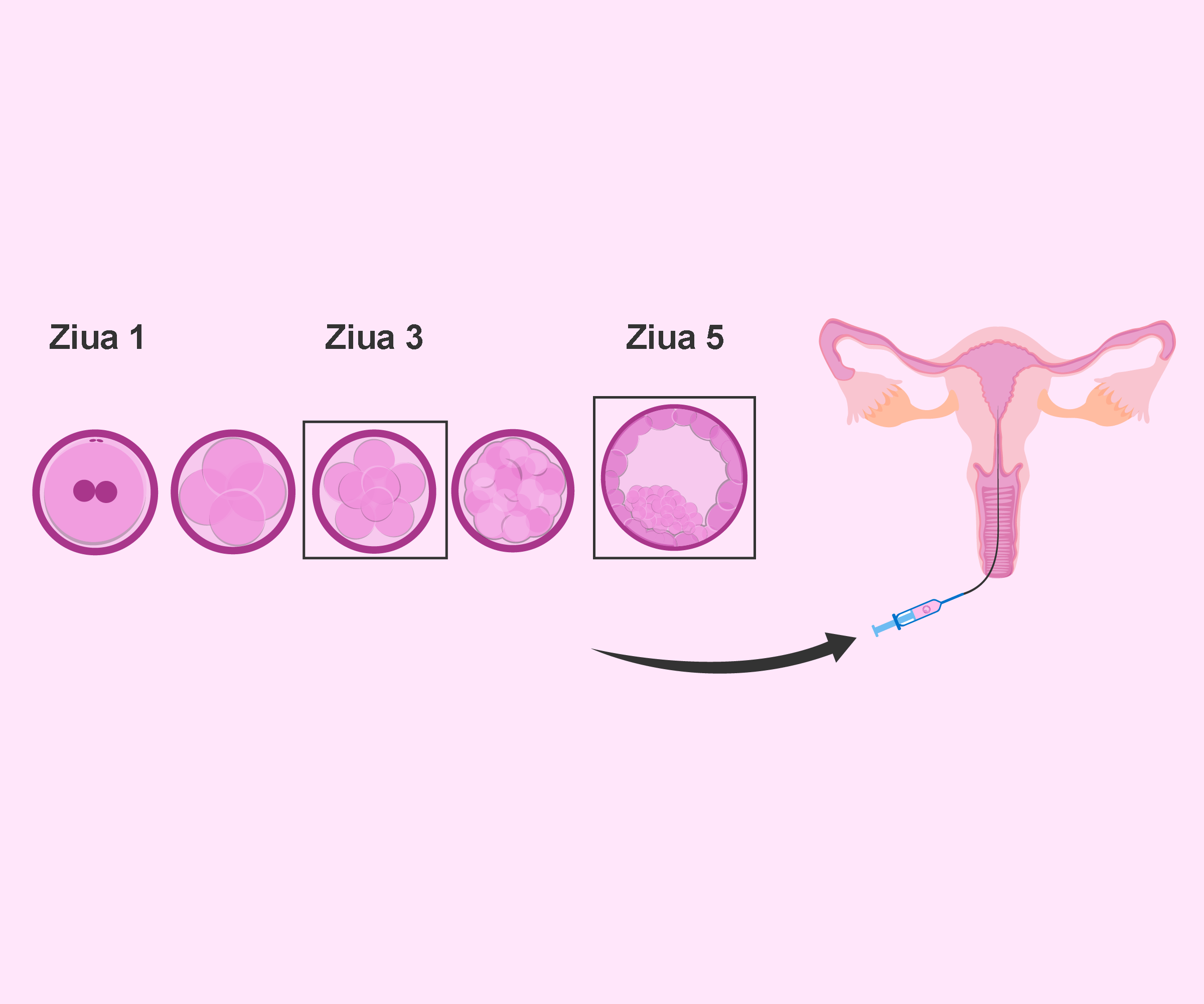 Transfer embrion de ziua 5 versus ziua 3